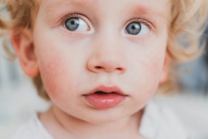 food allergies, eczema, or diathesis in a small child on the cheeks